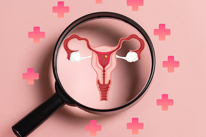 다낭성 난소 증후군이 뭐지?